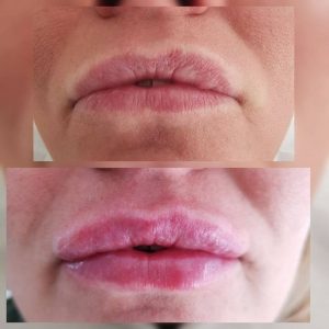 dermafiller-1