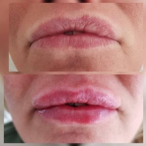 dermafiller-10