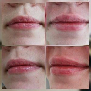 dermafiller-2