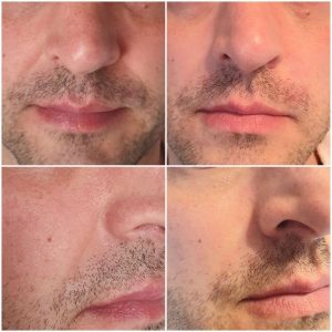 dermafiller-3