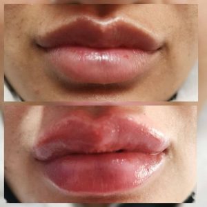 dermafiller-4