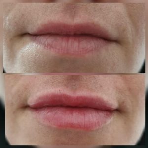 dermafiller-8