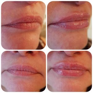derma-filler