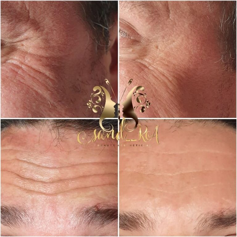 anti-wrinkle-injections-with-botulinum-toxin_pic2