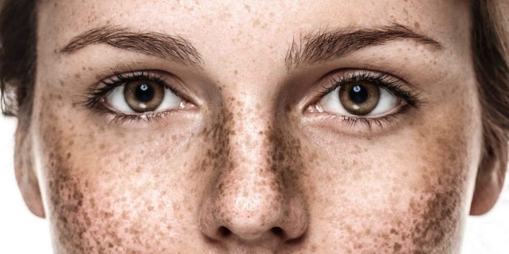 Pigmentation